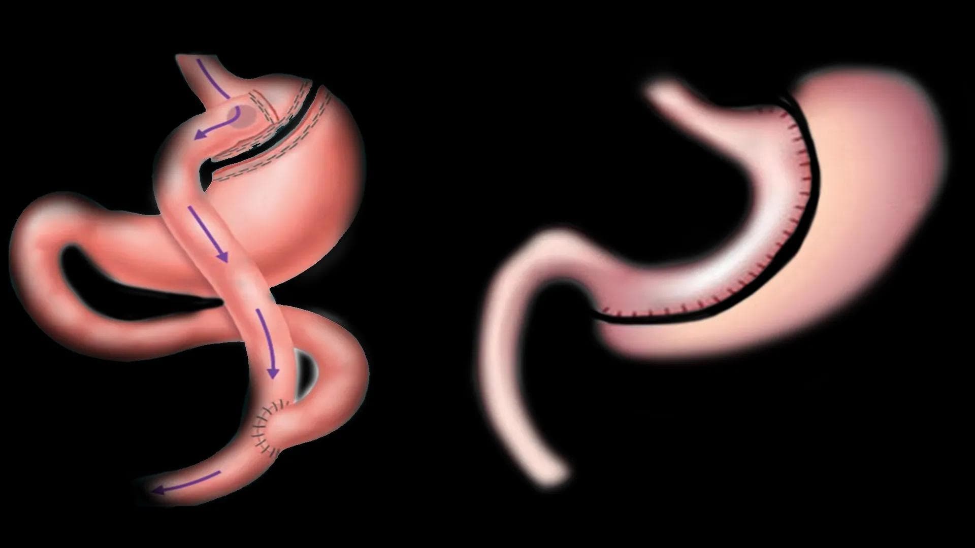 Revisional Bariatric Surgery