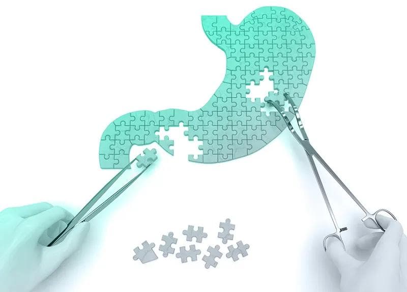 Gastric Band Revision Surgery