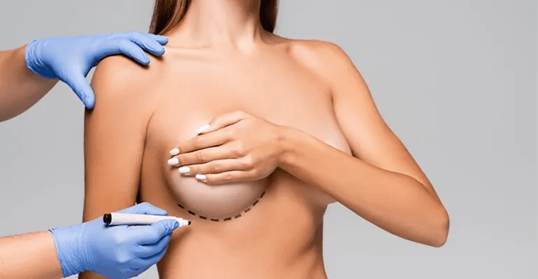 Breast Augmentation