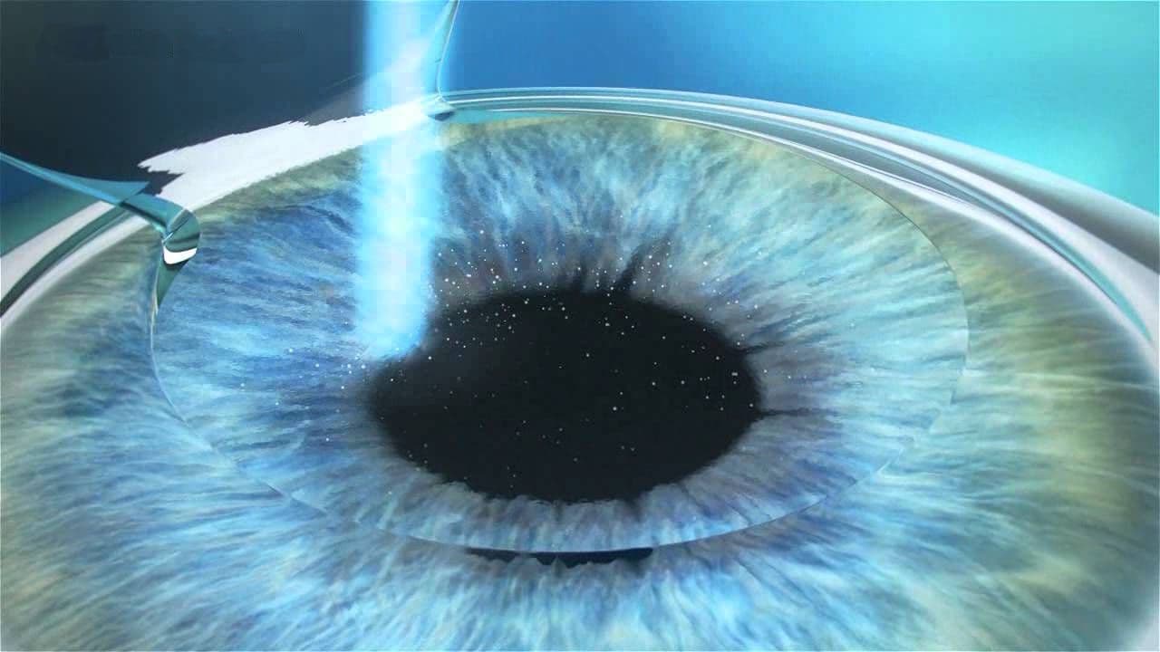 LASEK Eye Surgery