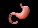 Mini Gastrik Bypass