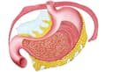 Gastrik Bypass Revizyonu