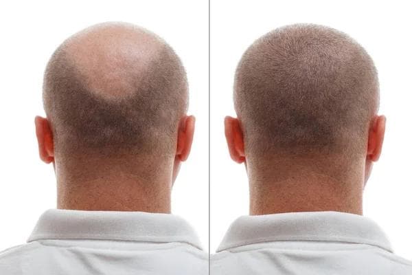 FUE Hair Transplant