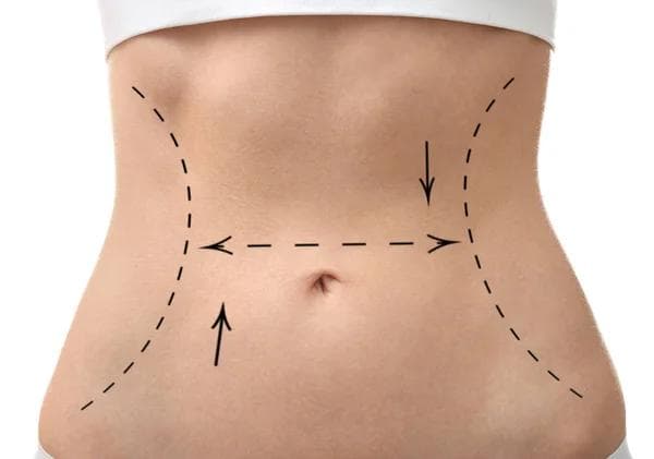 Liposuction
