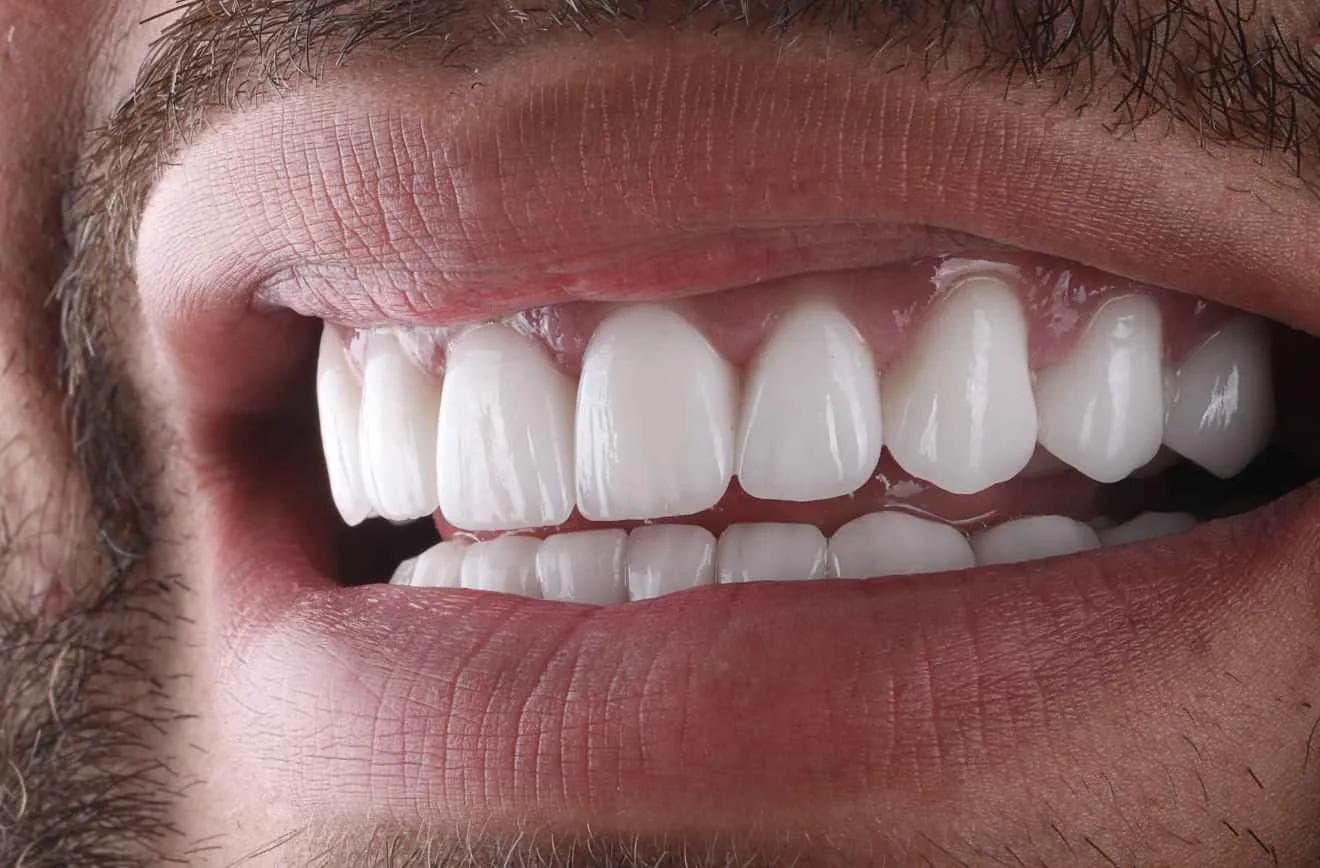 علاج تيجان الزركونيا
