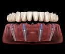All on 4 Dental Implants Turkey