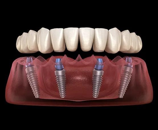 All on 4 Dental Implants Turkey