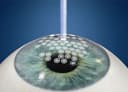 LASIK Eye Surgery
