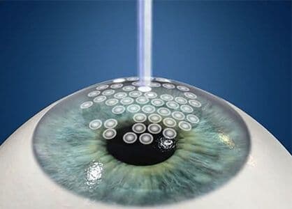 Lasik Göz Ameliyatı